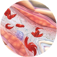Chronic vascular damage Chronic vascular damage